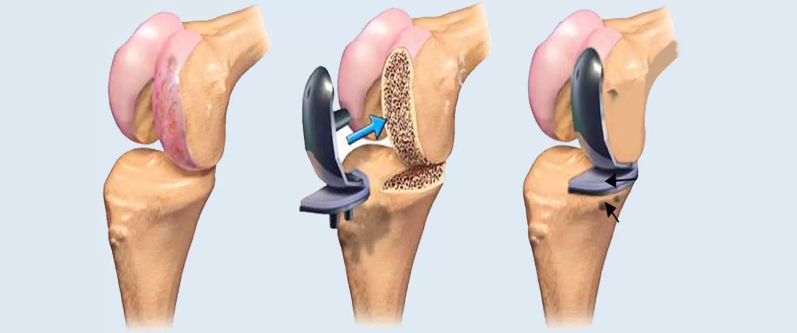 Joint Replacement Surgery in Etawah